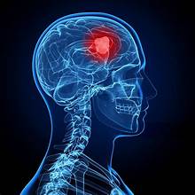 Understanding Brain Tumors: Symptoms, Risks, and Prevention