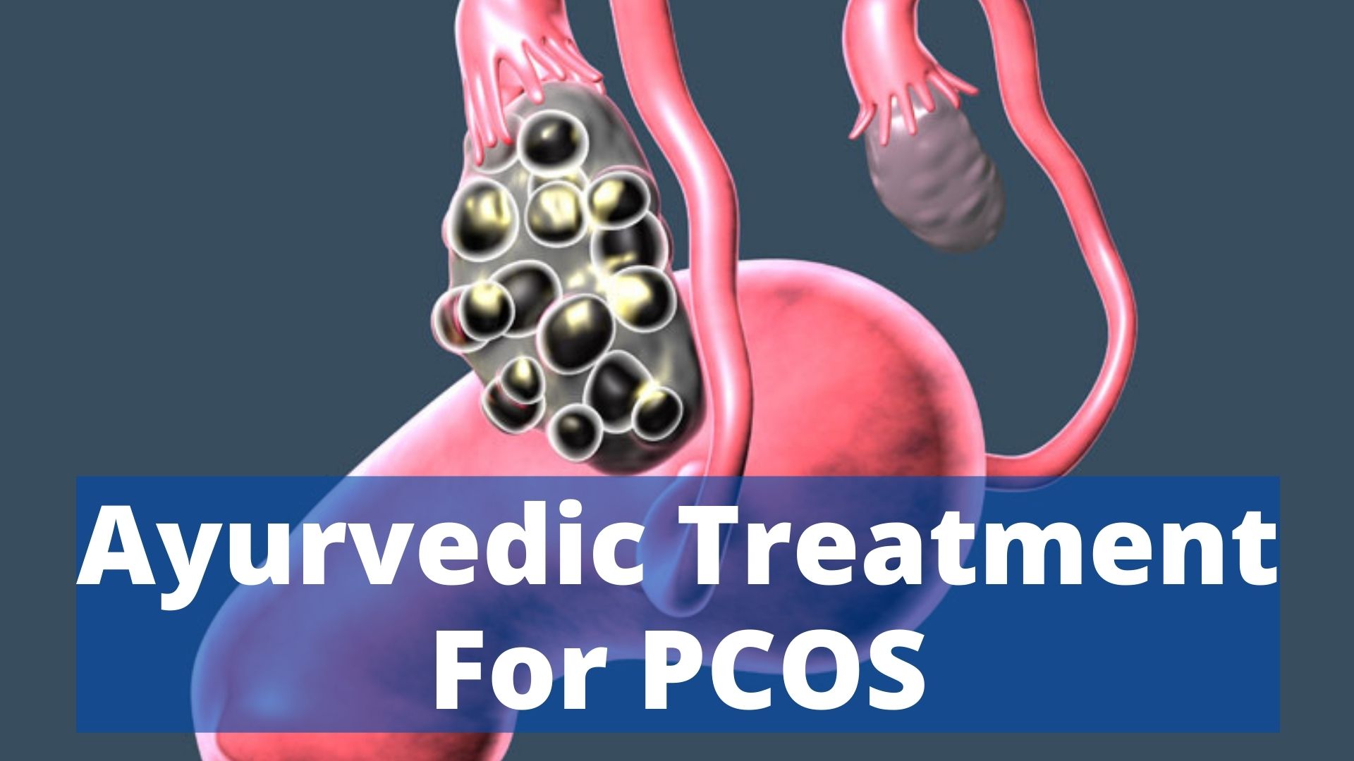 Impact of PCOS on Women's Health and Ayurvedic Methods to Manage it